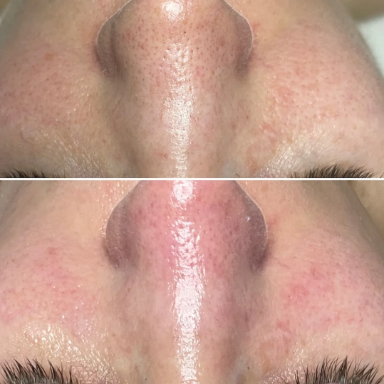 Teen Facial