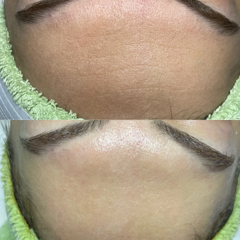 Dermaplaning Facial